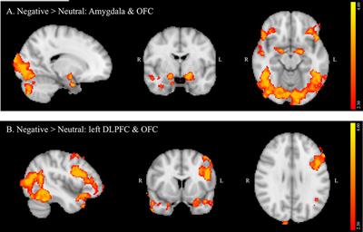 College Binge Drinking Associated with Decreased Frontal Activation to Negative Emotional Distractors during Inhibitory Control